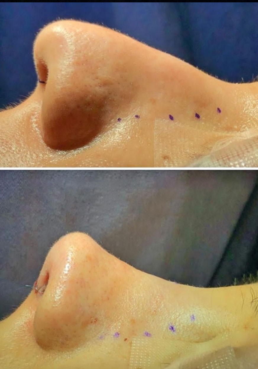 جراحی بینی اقساطی